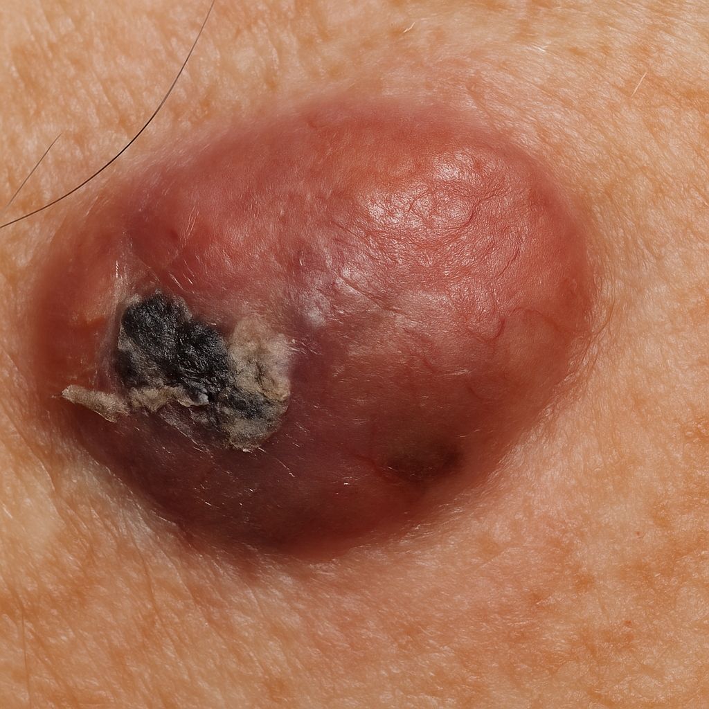 Skin Cancer on the Nose and Ear: Signs, Types, and When to Act