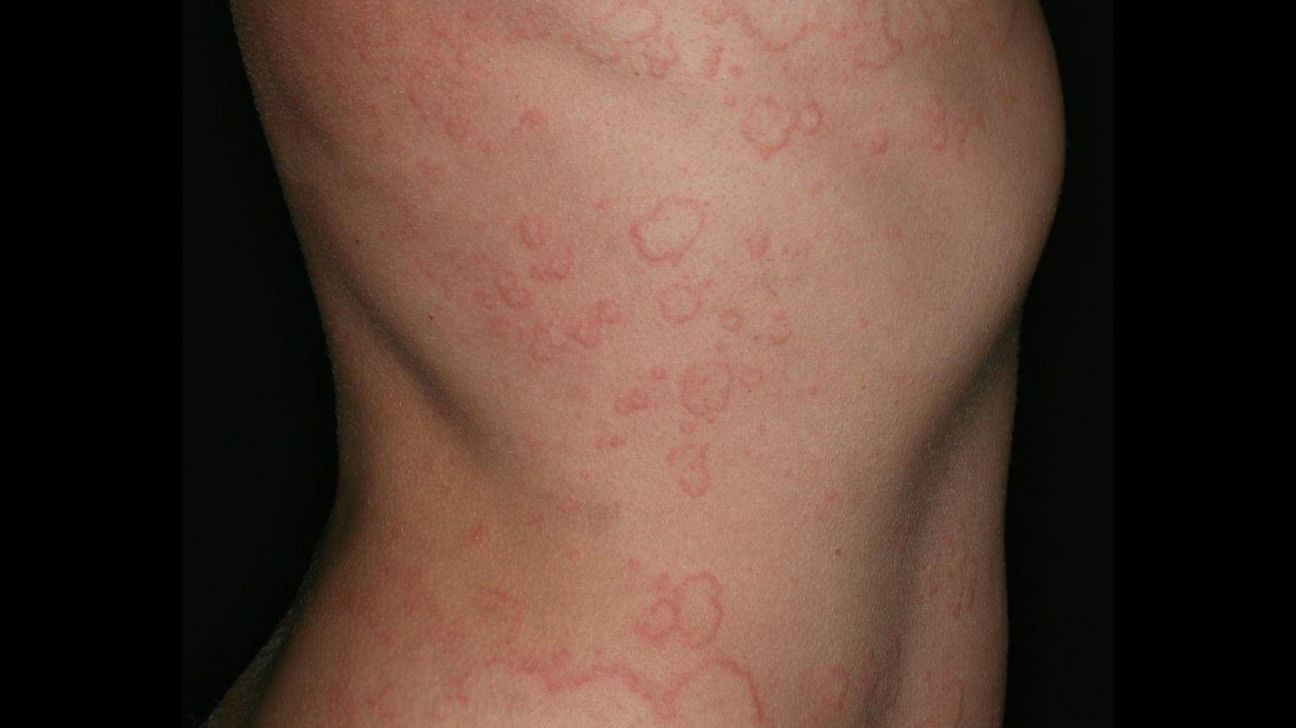 Autoimmune Skin Rash: Natural Remedies and Home Remedies That Work