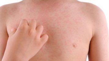 Lymphoma Skin Rash, Vitamin D Deficiency, and Recurring Rashes