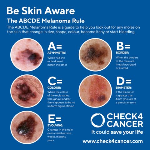 ABCs of Skin Cancer: The ABCDE Assessment Guide for Mole Detection