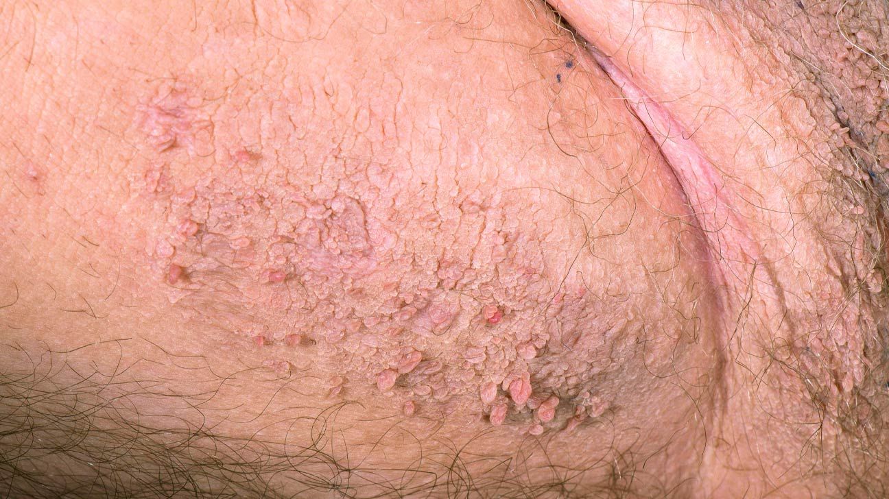 Skin Tag on Penis: Understanding and Managing the Condition