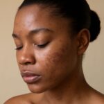 Acne on neck meaning and how to reduce redness of acne scars
