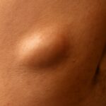 hard bumps under skin and hard knot under skin