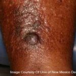 Can black people get skin cancer? Photodynamic therapy for skin cancer