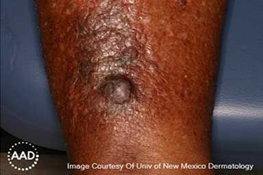 Can Black People Get Skin Cancer? Understanding Risks and Treatments