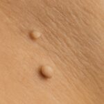 Understanding skin tag on scrotum and skin tag penis