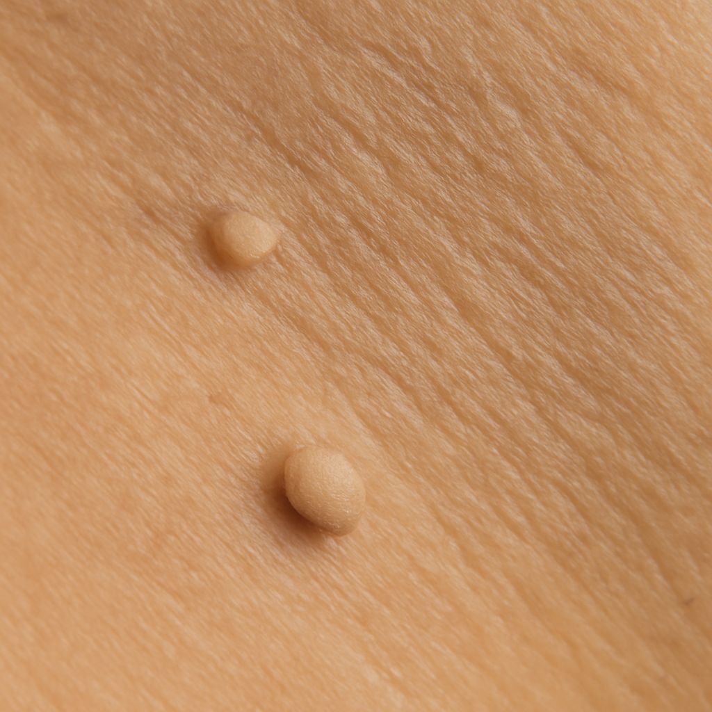Understanding skin tag on scrotum and skin tag penis
