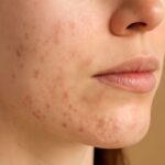 Can acne scars go away and do acne scars heal?