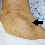 Illustration of hard lump under skin and hard nodule under skin