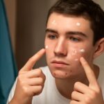 Learn how to get rid of cystic acne and prevent cystic acne scars