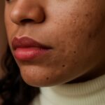 Home remedies for acne scars and natural remedies for acne scars