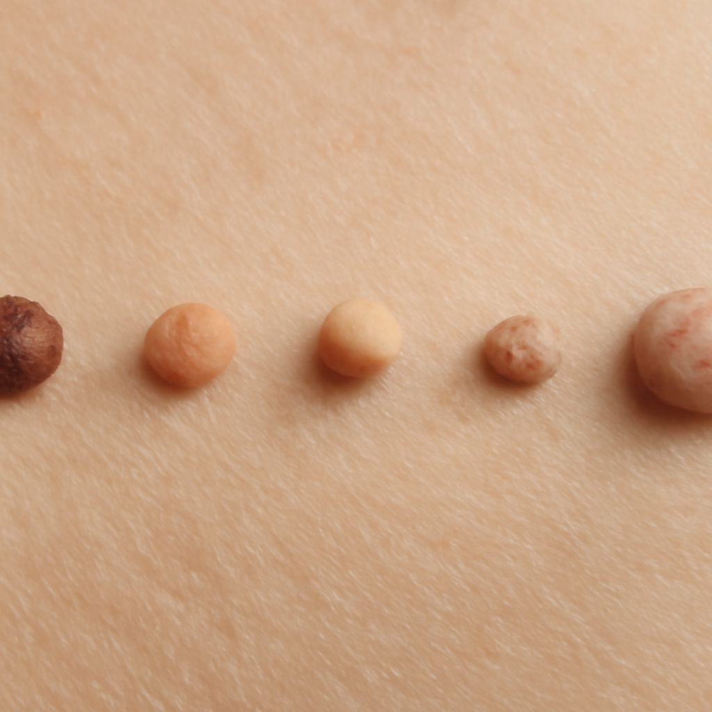 Skin tag vs mole, difference between skin tag and mole