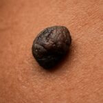 Skin tag turned black and black skin tag solutions