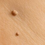 Understanding skin tags vs warts, including what a skin tag looks like
