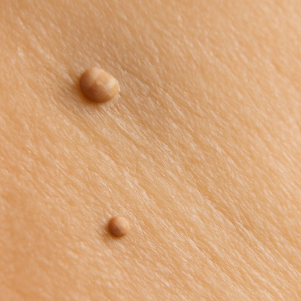 Skin Tag vs Wart: Understanding the Differences