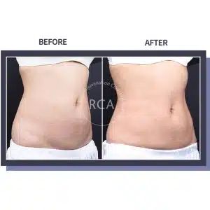 How to Tighten Skin After Weight Loss Naturally: Effective Tips and Techniques