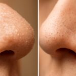 Understanding whiteheads vs blackheads and the difference between blackheads and whiteheads