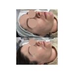 Chemical peel for acne and acne chemical peel benefits