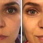 Best chemical peel and medium chemical peel for acne