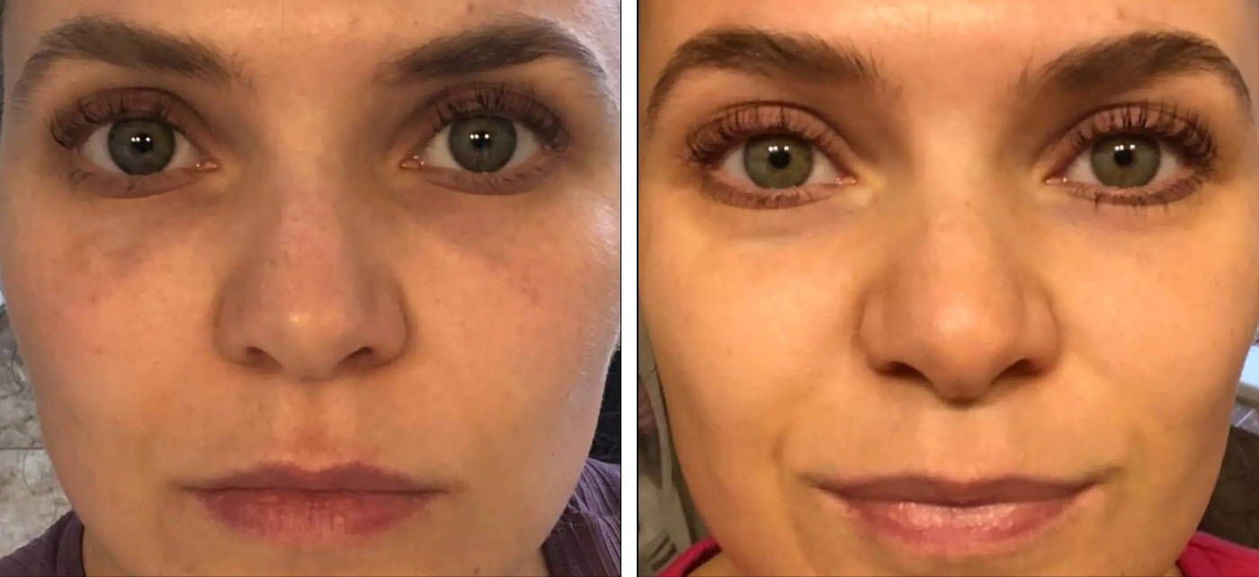 Best chemical peel and medium chemical peel for acne