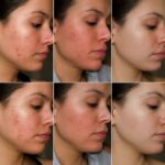Doxycycline monohydrate for acne treatment and cystic acne relief