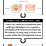 Chemical peels for acne scars and best chemical peel for acne scars