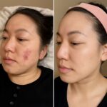 Acne facial treatment for facials and best results