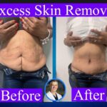 Loose skin on stomach and laser skin tightening options