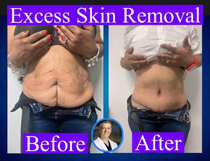Loose Skin on Stomach: Effective Solutions and Treatments