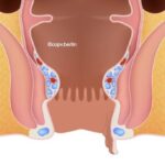 Perianal skin tag and hemorrhoid skin tag picture