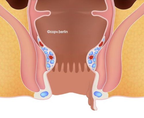 Understanding Perianal Skin Tags: Causes and Solutions