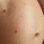 Skin tags during pregnancy and pregnancy skin tags