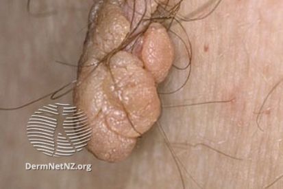 Skin Tag on Areola: Causes, Treatments, and Prevention
