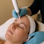 Laser acne treatment using laser for acne