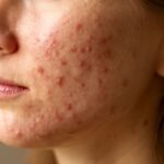 Does biotin cause acne and how biotin side effects impact skin