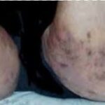 Blackheads on inner thighs and blackheads between thighs