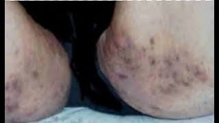 Blackheads on Inner Thighs: Causes and Solutions