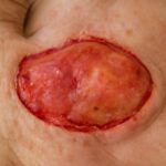 Skin graft healing stages pictures and skin graft before and after