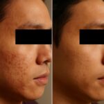Acne before and after transformation and back acne scars before and after