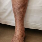 skin discoloration on legs and leg acne