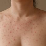 Gastric sleeve before and after skin, and gluten acne before and after