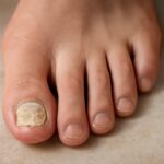 Guide to managing thick skin under toenail and dead skin around toenails