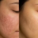 Pitted acne scars and subcision acne scars treatment