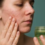 Jojoba oil for acne and how to use jojoba oil for acne