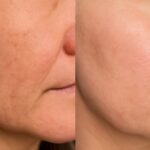 Best laser treatment and cost for acne scars