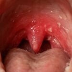 Skin peeling in mouth and causes of skin peeling inside mouth