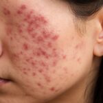 Comparison of nodular acne vs cystic acne, including post inflammatory hyperpigmentation acne