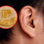 Dead skin on face and dead skin in ear canal