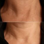 A guide to skin bridge removal and dealing with dehydrated acne prone skin