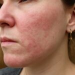 Skin picking disorder test and iodine skin test
